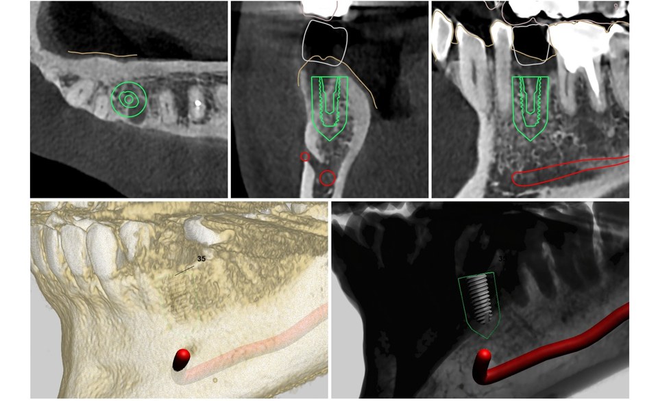 임플란트 CT 골량·골밀도 분석